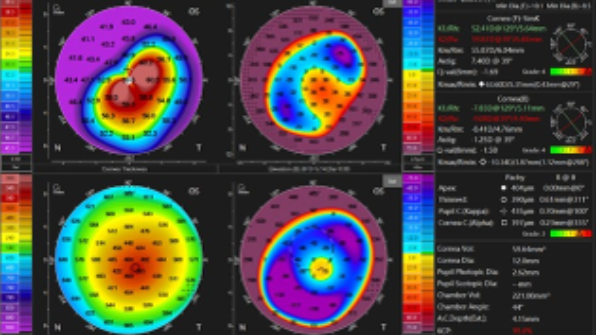Planejamento pré e pós-operatório em cirurgia refrativa